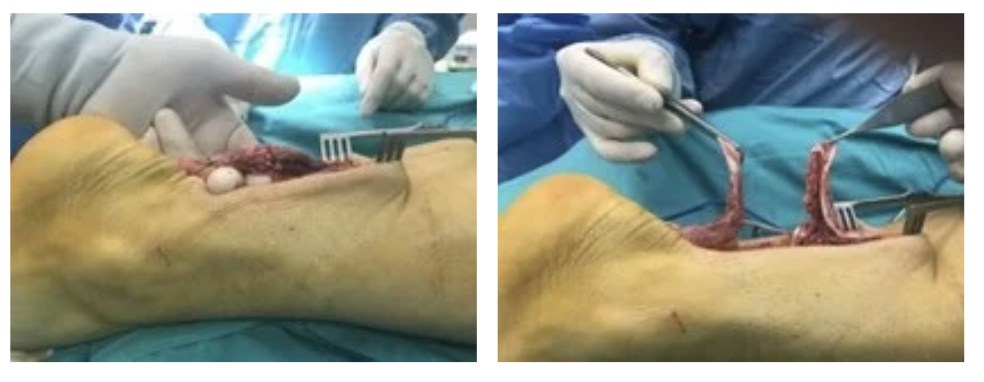 50 yaşında erkek hastanın spor yaparken kopan Aşil tendonun ameliyat görüntüleri. Soldaki fotoğrafta kopmuş olan Aşil tendonu, sağda ise cerrahi olarak onarılan tendon görülmekte.