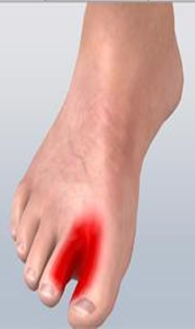 Anterior tarsal tünel sendromunda duyu kaybı, uyuşma ve karıncalanma olan bölge.