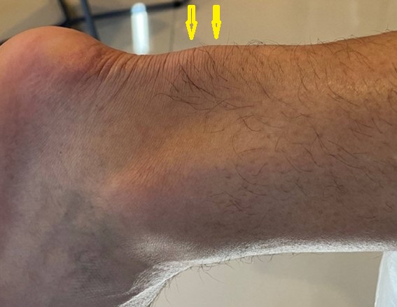 Aşil tendinitli sporcu bir hastada tendonun orta bölümünde (noninsersiyonel Aşil tendiniti) belirgin şişlik (okla gösterilmiştir) görülmekte