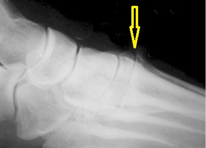 Ayak sırtında derin peroneal sinirin sıkışmasına neden olan kemik çıkıntısının röntgen görüntüsü