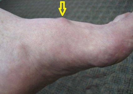 Ayak sırtında derin peroneal sinirin sıkışmasına neden olan kemik çıkıntısı.