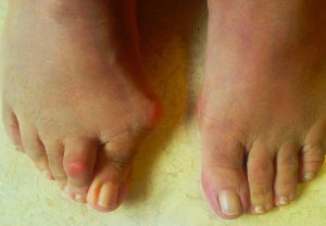Daha önce sol ayağından halluks valgus ameliyatı olmuş kadın hastanı sağ ayağında ileri evre halluks valgus ve ikinci parmakta çekiç parmak deformitesi ve ayakkabı giymeyi güçleştiren ağrılı nasır görülmekte