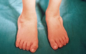 Fotoğrafta diplejik çocuk bir hastanın ayak başparmaklarında erken evre halluks valgus gözlenmekte.