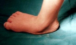 Fotoğrafta diplejik çocuk bir hastanın ileri derecedeki paralitik pes planovalgus deformitesi görülmekte.