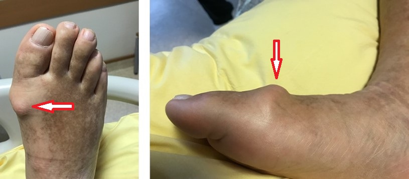 Halluks rijiduslu bir hastanın ayak fotoğrafı. Ayak başparmağının tarak kemiği ile eklem yaptığı bölgede, çoğunlukla eklemin üstünde ele gelen kemik çıkıntısı gözlenmekte.