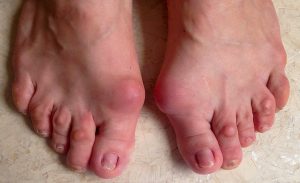 Halluks valgus kadın hastada küçük parmaklarda çekiç parmak deformitesi ve ayakkabı giymeyi güçleştiren ağrılı nasırlar görülmekte.