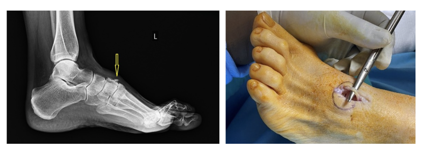 Soldaki resimde anterior tarsal tünel sendromu olan bir hastanın röntgeninde ayak sırtında derin peroneal sinirin sıkışmasına neden olan kemik çıkıntısı görülmekte. Sağdaki resimde aynı hastanın ameliyatında kemik çıkıntısının çıkartılmış ve sinirin gevşetilmiş olduğu görülmekte