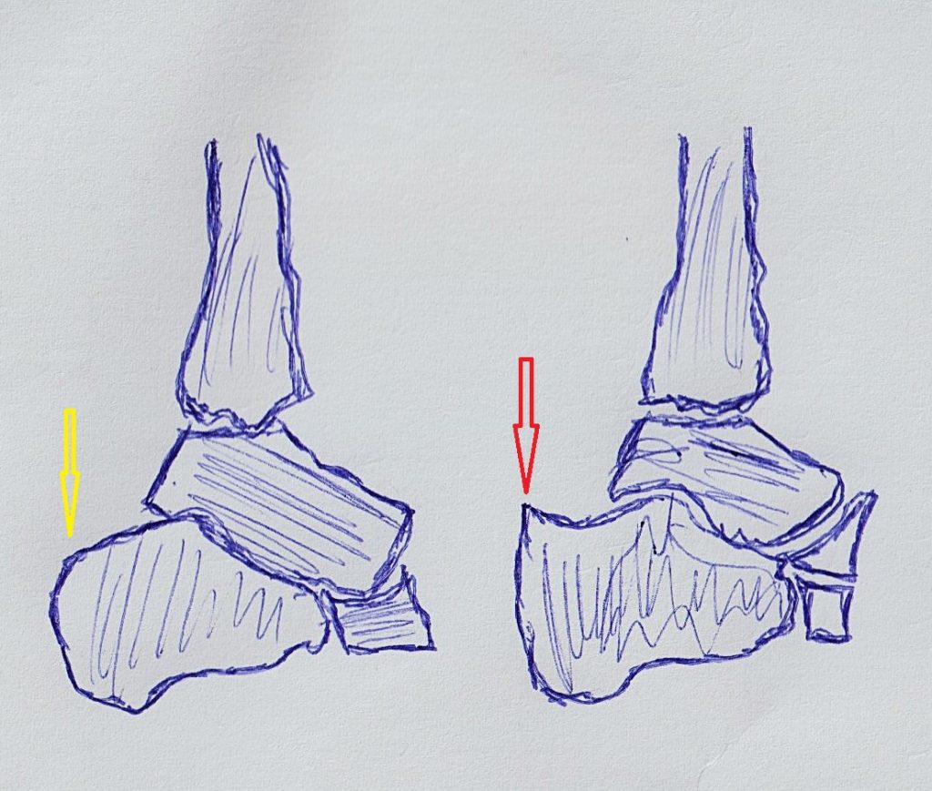 Solda sarı okla gösterilen normal topuk kemiği (kalkaneus kemiği), sağda ise kalkaneusun arka üst tarafında kırmızı okla gösterilmiş olan Haglund deformitesi.