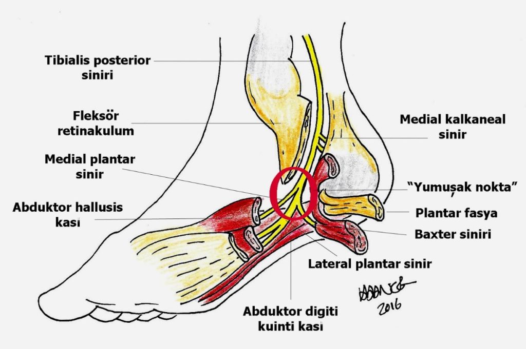 Tarsal tünel sendromunu ameliyatının şematik görüntüsü.
