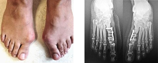 Çift taraflı ileri evre halluks valgus'u olan 40 yaşındaki kadın hastanın ayaklarının ameliyat öncesi fotoğrafı ve ameliyat sonrası röntgenleri. <yoastmark class=