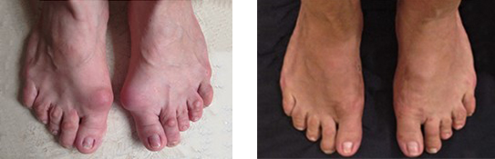 Her iki ayağında ileri evre halluks valgus olan bir hastanın ameliyat öncesi ve sonrası görüntüsü. Her iki ayakta küçük parmaklarda çekiç parmak ve nasırların görülmektedir.