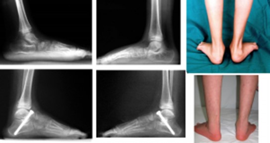  Diplejik çocuk bir hastanın her iki ayağındaki ileri derecedeki paralitik pes planovalgus deformitesi görülmekte. Ayak röntgenlerinde ayak tabanında kemikler tarafından oluşturulan kemerin tamamen çöktüğü gözlenmekte. Her iki ayağa yapılan düzeltici kemik ameliyatı sonrası röntgenlerde kemik kemerinin yeniden oluştuğu ve fotoğraflarda da düzelmenin belirgin olduğu görülmekte.