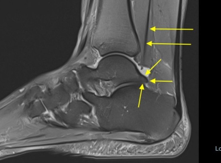 Posterior ayak bileği sıkışma sendromlu hastanın MR görüntüsünde Stieda çıkıntısı (kısa oklar) ve fleksör hallusis longus tendonu (uzun oklar)