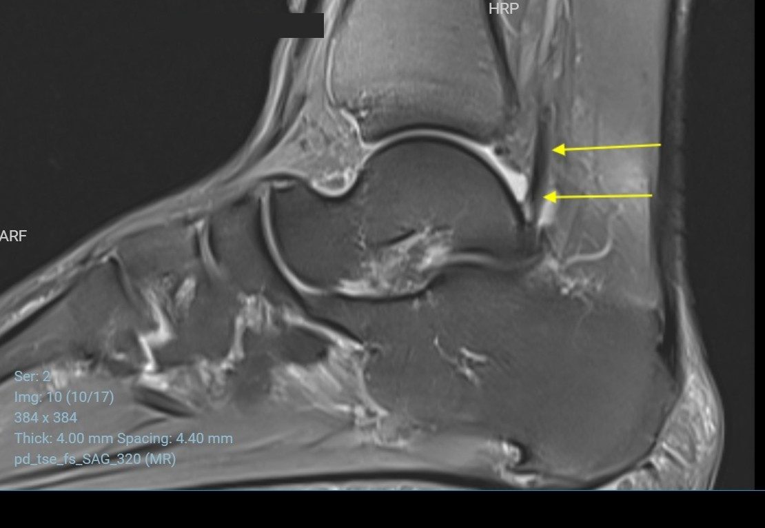 Fleksör hallusis longus tendonunun Stieda çıkıntısına sürtünerek posterior ayak bileği sıkışmasına neden olduğu görülmekte