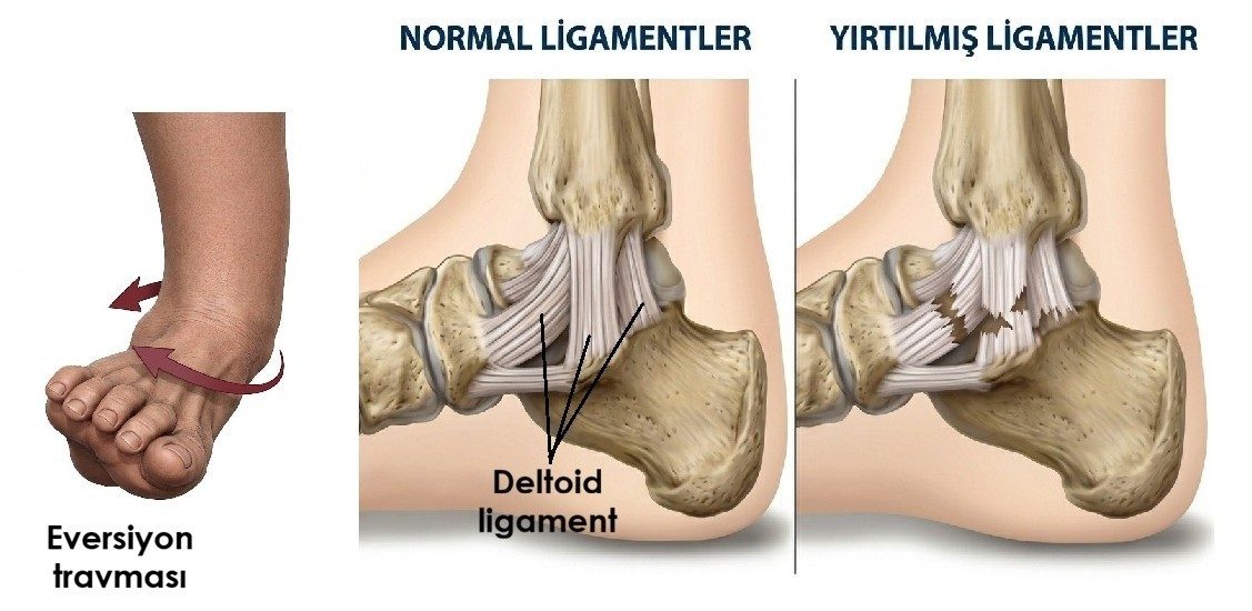Ayak bileğinde eversiyon travması sonucunda iç yan taraftaki deltoid ligamentin yırtılması