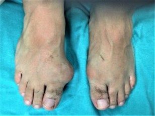 60 yaşında erkek hastanın ayak başparmağındaki belirgin tofüs oluşumu