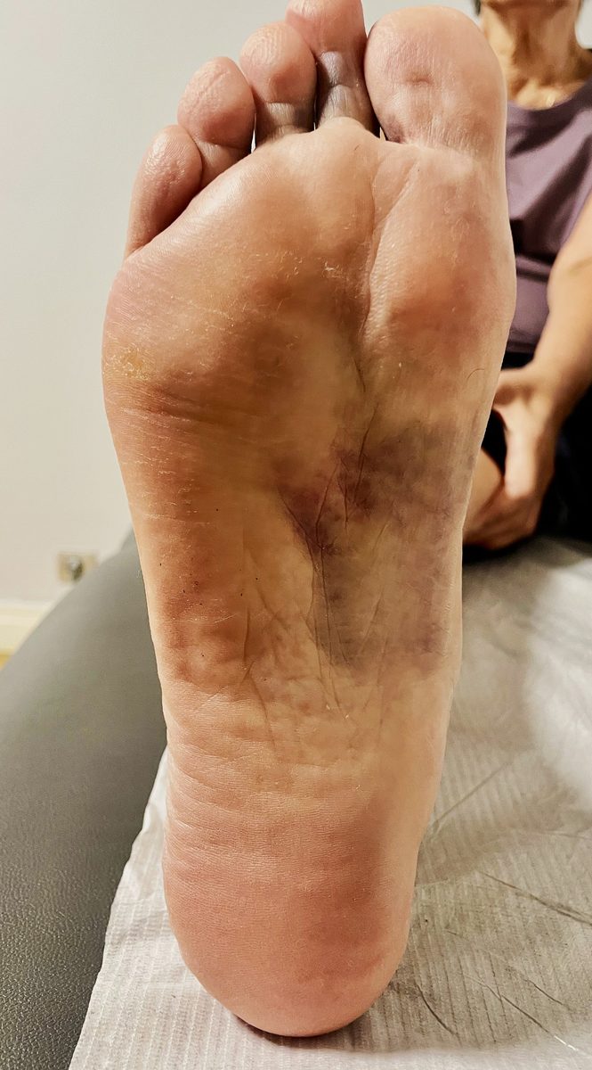 Lisfranc yaralanması olan bir hastanın ayak tabanında görülen morarma (plantar ekimoz)