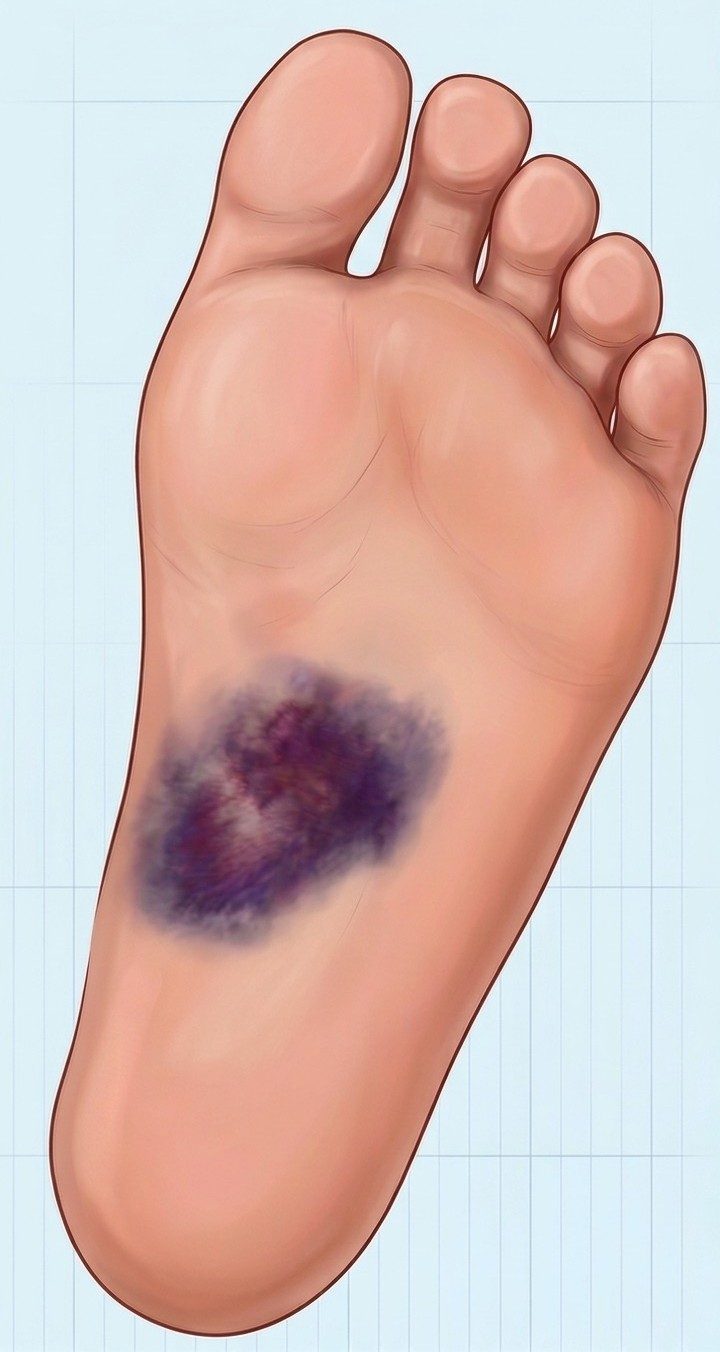 Lisfranc yaralanmalarında ayak tabanında ortaya çıkan morarma (plantar ekimoz)