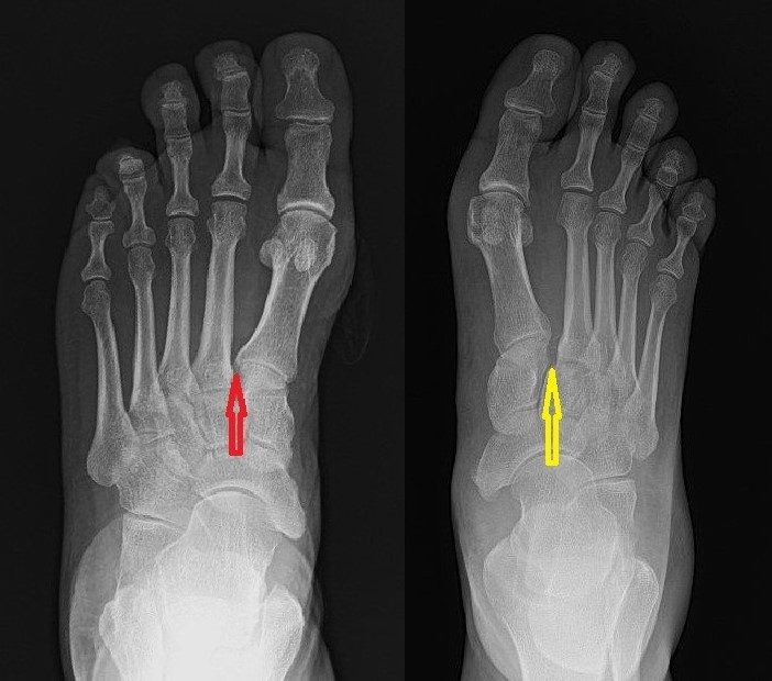 Sol ayakta kırmızı okla gösterilen normal Lisfranc eklemi ve sağ ayakta travma sonrası sarı okla gösterilen ayrışmış