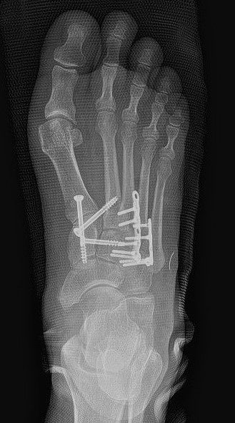 Lisfranc kırıklı çıkığı ameliyatı sonrası plak ve vidalarla tespit edilmiş ayağın üstten çekilmiş röntgeni