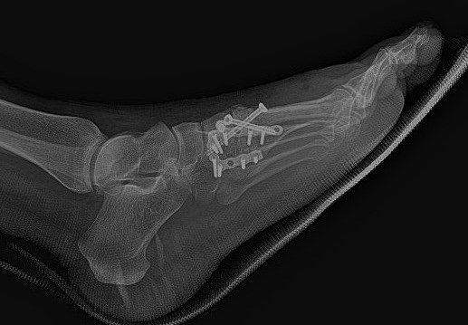 Lisfranc kırıklı çıkığı ameliyatı sonrası plak ve vidalarla tespit edilmiş ayağın yandan çekilmiş röntgeni